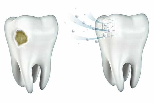 Xylitol and Remineralization of Teeth: A Literature Review